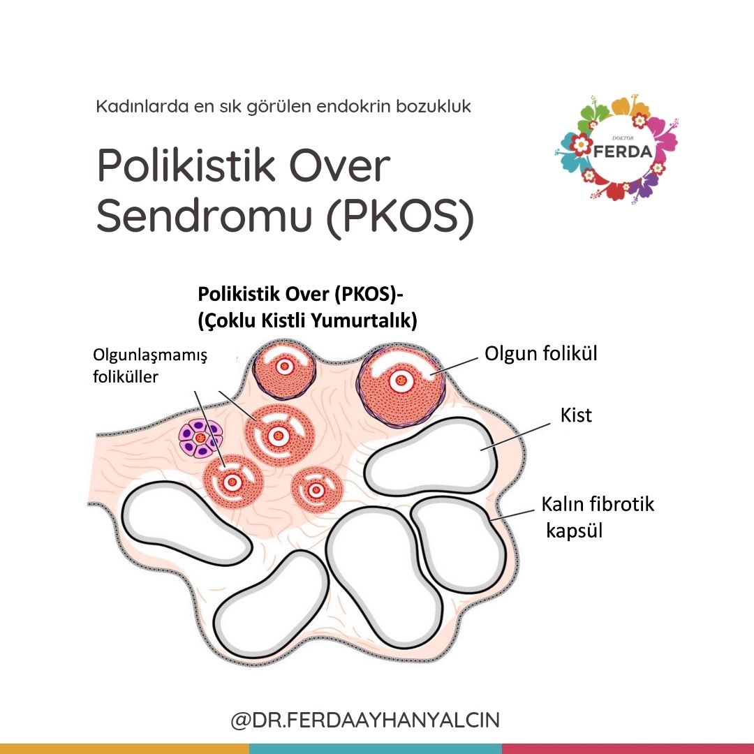 Polikistik Over Sendromu (PKOS) | Dr. Ferda Ayhan Yalçın | Fonksiyonel Tıp